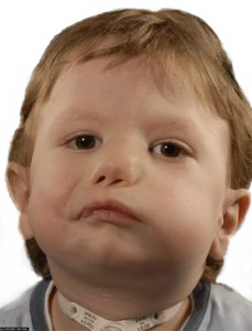 Child with Moebius syndrome