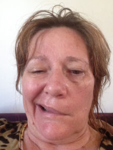Elizabeth trying to smile with movement only on one side of her face