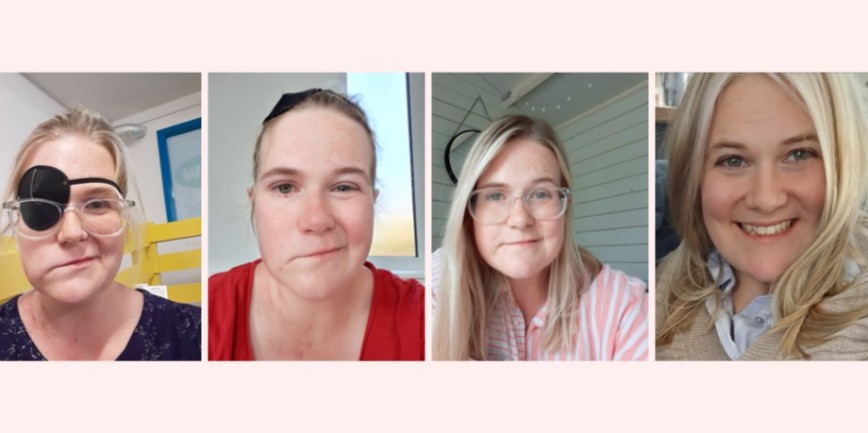 4 images of a woman with facial palsy showing her gradual recovery.