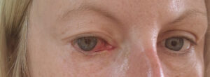 Eyes with left one red and sore.